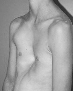 Какие патологии грудной клетки существуют ?